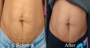 Non Surgical Tummy Tightening